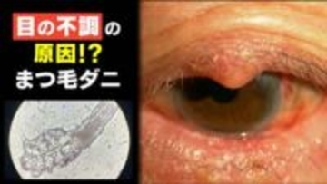 顔の毛穴に寄生し皮脂を食べる「ダニ」… 増殖すると眼瞼炎やドライアイなどの原因にも まつ毛エクステやアイメイクをしている人は要注意【まつ毛ダニ】