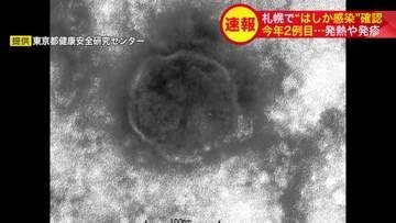 【速報】札幌で今年2例目のはしか感染確認＿インドから帰国の50代女性、発熱・発疹で13日に陽性判明…市保健所が予防接種と早期受診を呼びかけ感染拡大に警戒