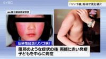 子どもを中心に発症「リンゴ病」　山形県内で流行続く…31週連続で警報レベル