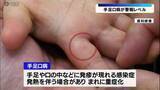 「「手足口病」警報レベルに拡大・山形市と庄内の保健所管内で」の画像1