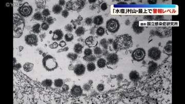 水ぼうそう患者数が警報レベル　山形県の村山と最上の保健所管内で