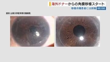 海外ドナーからの角膜移植 山梨大が県内初実施「チャンス増える」手術件数が増加へ