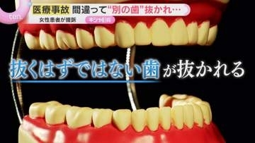 【ナゼ】間違って“別の歯”抜かれて入れ歯に…患者(67)が賠償求め提訴