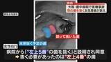 「【独自】誤って別の歯を抜かれ入れ歯を余儀なく…市立豊中病院で”医療事故”　患者が豊中市に約390万円の賠償求め提訴」の画像1