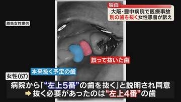 【独自】誤って別の歯を抜かれ入れ歯を余儀なく…市立豊中病院で”医療事故”　患者が豊中市に約390万円の賠償求め提訴