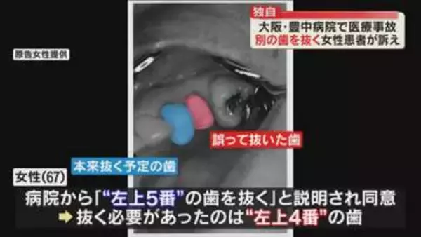 【独自】誤って別の歯を抜かれ入れ歯を余儀なく…市立豊中病院で”医療事故”　患者が豊中市に約390万円の賠償求め提訴