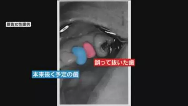 【独自】違う歯を抜かれ入れ歯に…医療事故で女性が豊中市に損害賠償求め　病院は“誤った診断”認める