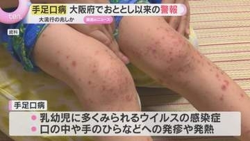 大流行の兆しか　手足口病が大阪府で警報レベルに　患者の約半数が１歳児