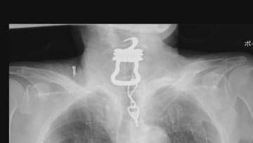 【速報】入院中に死亡した男性の喉から「カギ」 遺族が提訴も病院側は争う姿勢「カギの誤飲と死亡は因果関係持たず」と主張