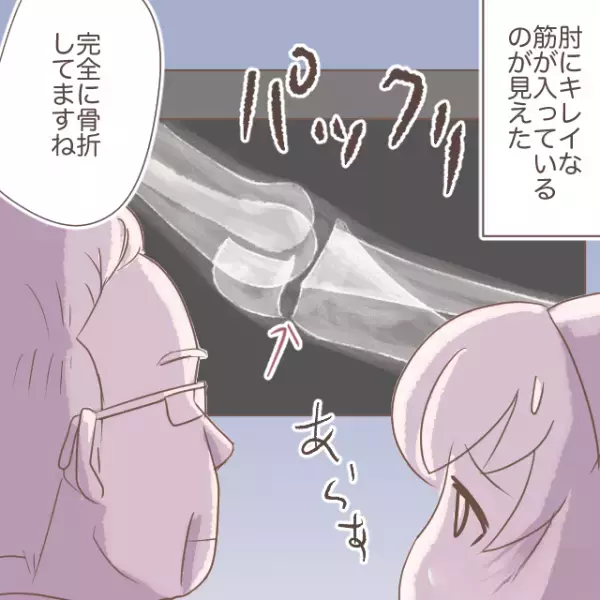 体育で肘をケガした息子「大丈夫！」しかし→お風呂に入ろうとすると「痛いぃぃ！」→病院へ行くと医者から【まさかの診断結果】を言い渡される