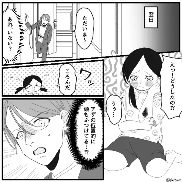 日に日に“アザが増える”娘？医者「お子さんは…」⇒告げられた【診断結果】に妻の血の気が引いたワケ