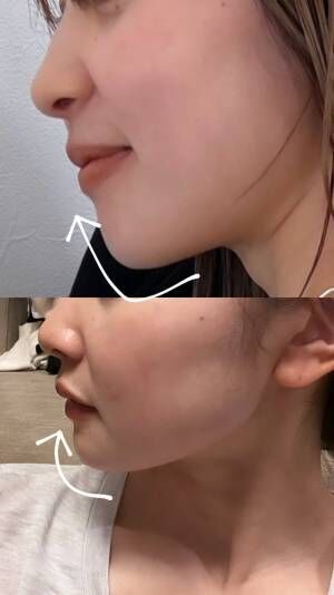 感激だった韓国の美容クリニックレポ「たった3万弱で顔が変わったー！！！笑」