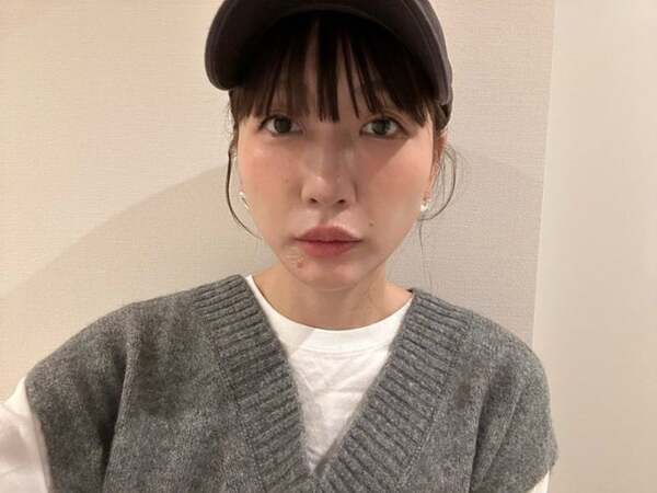 あいのり・桃、美容施術後の心境を吐露「ダウンタイムだいぶましだー！」