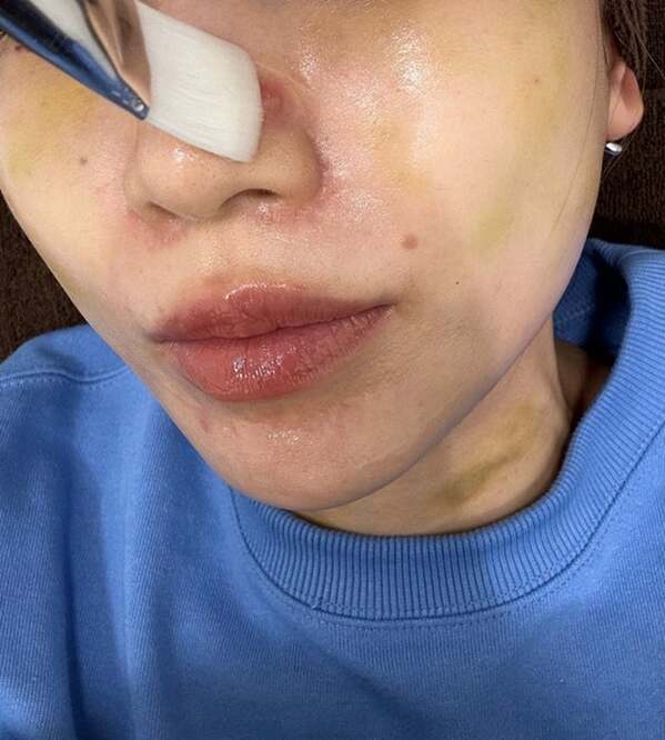 あいのり・桃、医師も驚きのニキビ治療を報告「なかなか珍しいですねって言われた」