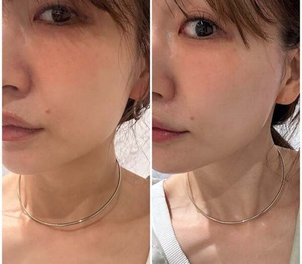 あいのり・桃、糸リフト施術後の変化に驚き「中顔面が短く見える気がしない？！」