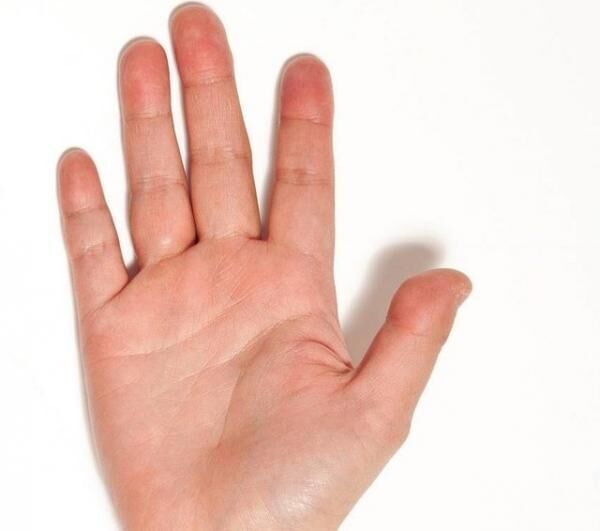 指が短い例。指の長さが手のひらと比べてかなり短め。思ったことをすぐ口にしたり、行動に移したりする人。<div class=