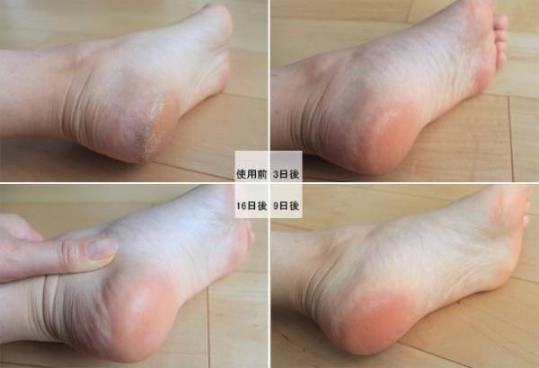 あのお悩みにサヨナラ！赤ちゃんのようなかかとを今すぐ手に入れよう[PR]