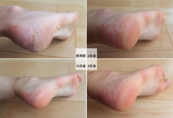 見て見ぬフリしていたあのかかとにサヨナラ！今年はモチモチかかとを手に入れよう。[PR]