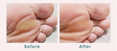 ヒールダコやひび割れ踵もなかったことに？この夏、つるるん素足でお出かけしよう。[PR]