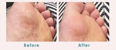 ヒールダコやひび割れ踵もなかったことに？この夏、つるるん素足でお出かけしよう。[PR]