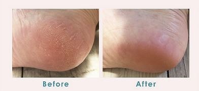 ヒールダコやひび割れ踵もなかったことに？この夏、つるるん素足でお出かけしよう。[PR]