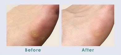 ヒールダコやひび割れ踵もなかったことに？この夏、つるるん素足でお出かけしよう。[PR]