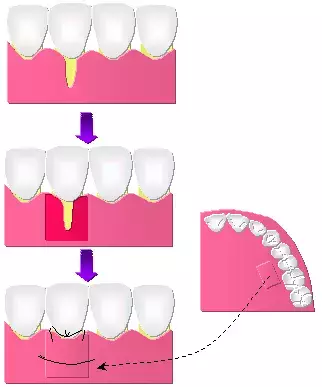 「歯のすきまが気になる…」マツコも受けた、歯茎の移植手術って？