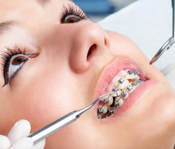 期間・費用・痛み・・・【実体験】大人になってからの「歯科矯正」ぶっちゃけどうだった？