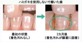 歯の明るさは顔印象を左右する!? マスク生活のうちに始めたい歯の美白ケア