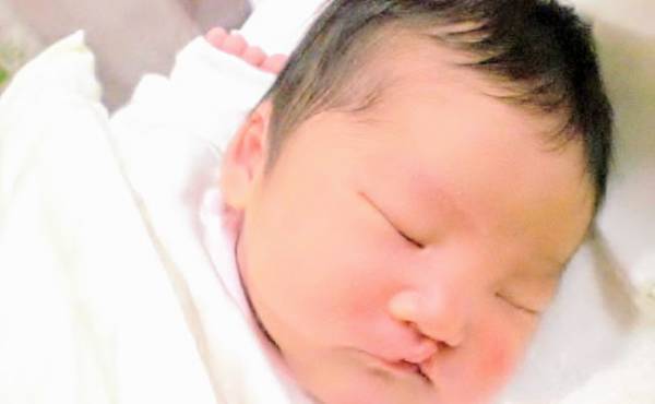 生まれてから口唇口蓋裂と判明。 妊娠中から手術を受けるまで【体験談】
