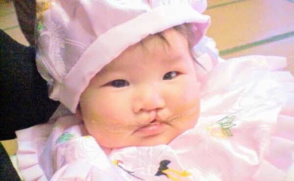 口唇口蓋裂の赤ちゃんの写真