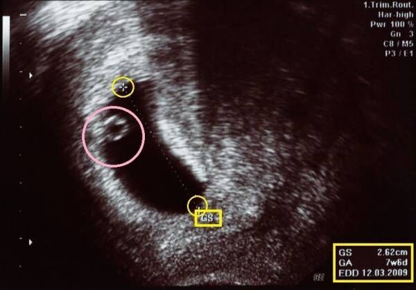 妊婦健診でもらった 超音波写真 どうやってみる 何がわかるの 19年5月6日 ウーマンエキサイト 1 2