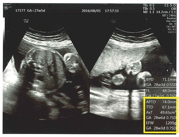 妊婦健診でもらった「超音波写真」どうやってみる？ 何がわかるの？！