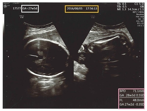 妊婦健診でもらった「超音波写真」どうやってみる？ 何がわかるの？！