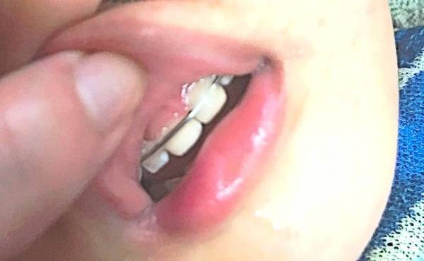 ブランコから落下で1歳次男の前歯が折れた！ 大後悔から得た教訓とは