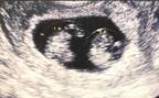 初めての妊娠が双子！私が不安な気持ちを払拭できた理由【体験談】