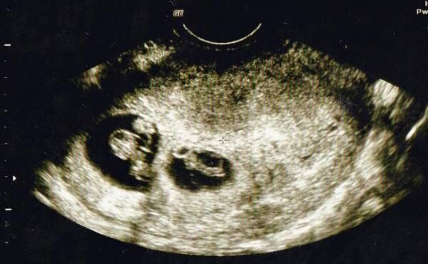 三度目の妊娠でまさかの 三つ子 だった 不安と喜びの妊娠体験談 19年8月10日 ウーマンエキサイト 1 2