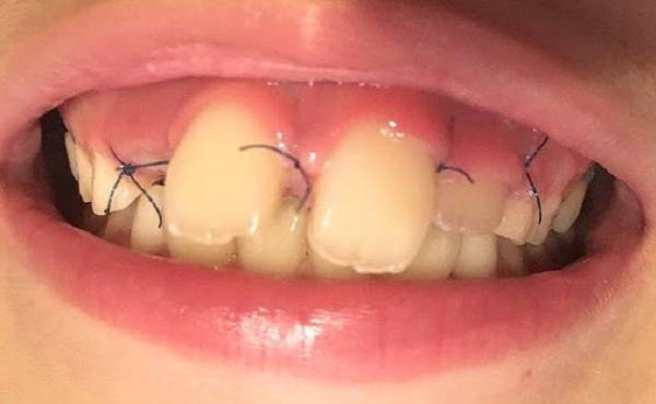 過剰歯って何？ 歯医者のレントゲンで映った3本目の上前歯【体験談】