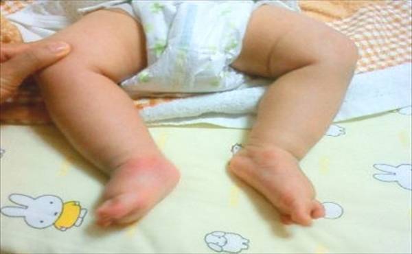 右足首が曲がってる…生まれてきた子どもは先天性内反足でした【体験談】