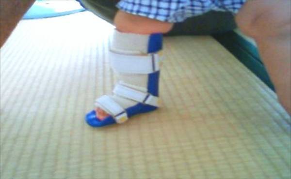 右足首が曲がってる…生まれてきた子どもは先天性内反足でした【体験談】