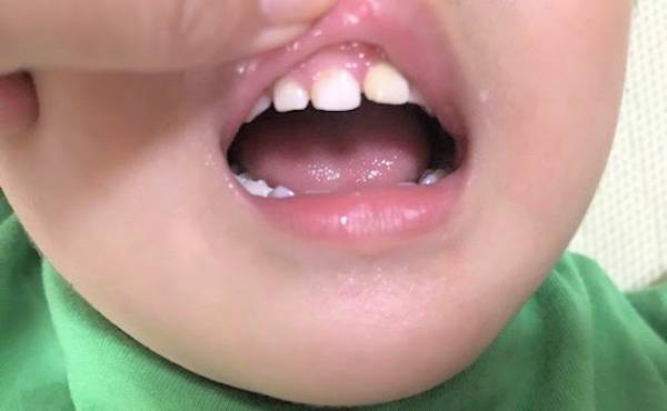 ブランコから転落、前歯が折れた…いつ抜けてしまうかと不安だった体験談