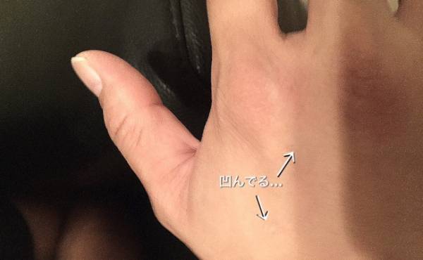 陣痛の痛みがパパの手に消えない傷を残す…！？【出産体験談】