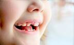 1歳ですべての歯の虫歯と糖尿病を予告された娘【ママの体験談】