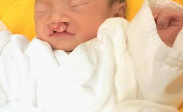 口が切れてる？ 生まれた子は「両側完全口唇口蓋顎裂」でした【体験談】