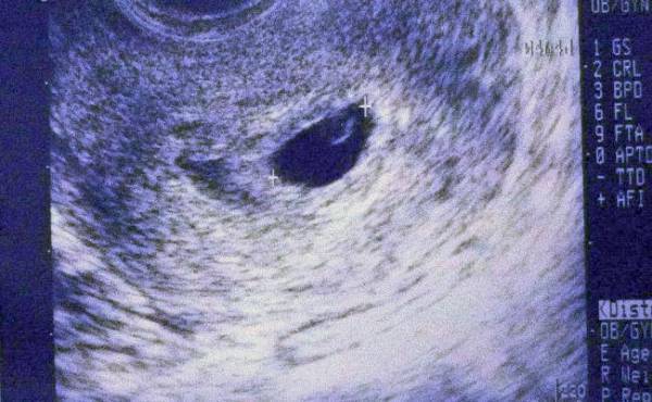 羊水過多は胎児障害のサイン？ 小さめだった赤ちゃんは無脳症でした。