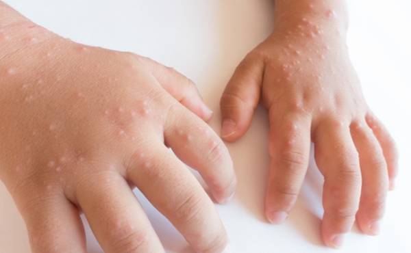 今年は早くも流行の兆し？妊娠中、手足口病にかからないためにできること