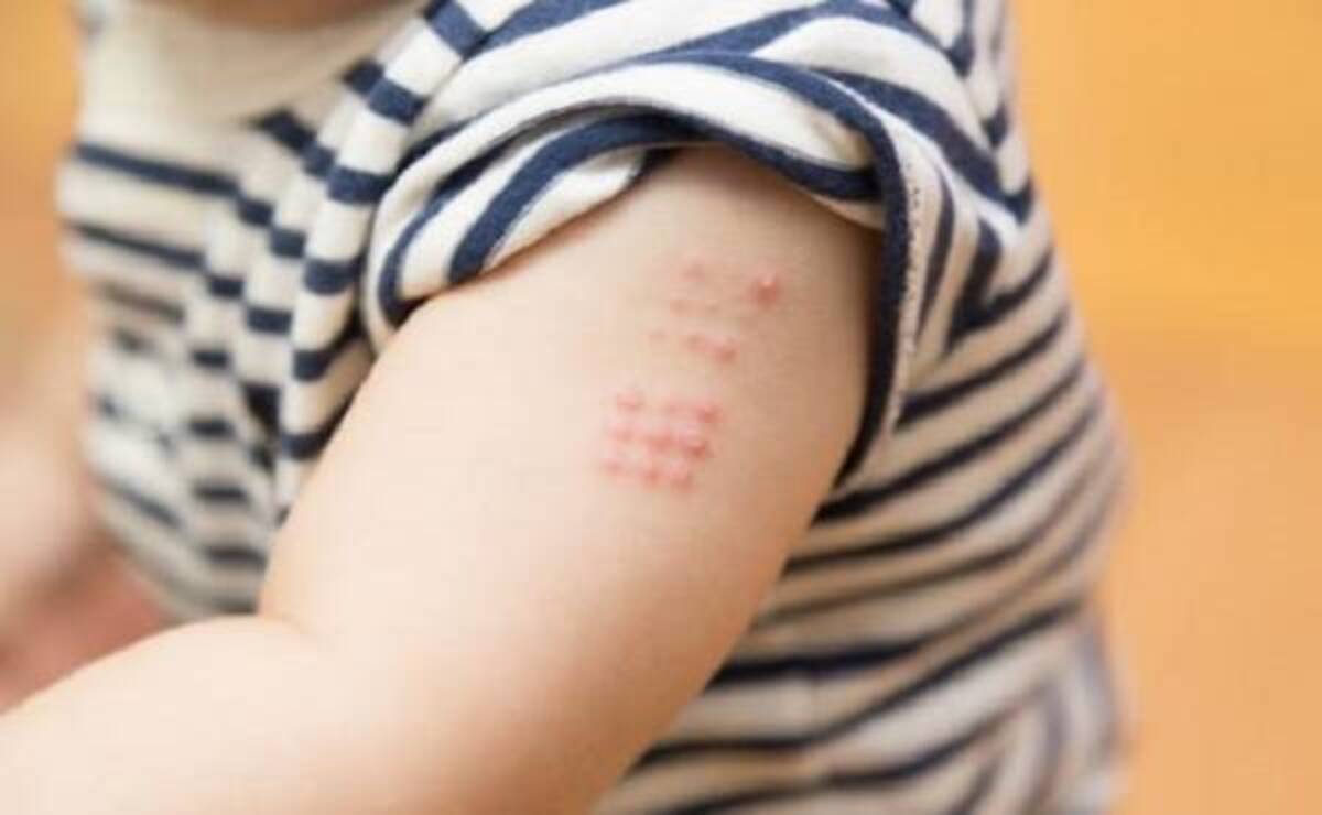 赤ちゃんの手が腫れている 予防接種の副反応について助産師が回答 19年5月4日 ウーマンエキサイト