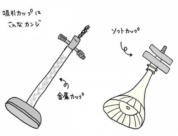 【お産の緊急処置】吸引分娩になるときって？！吸引分娩の方法とリスク