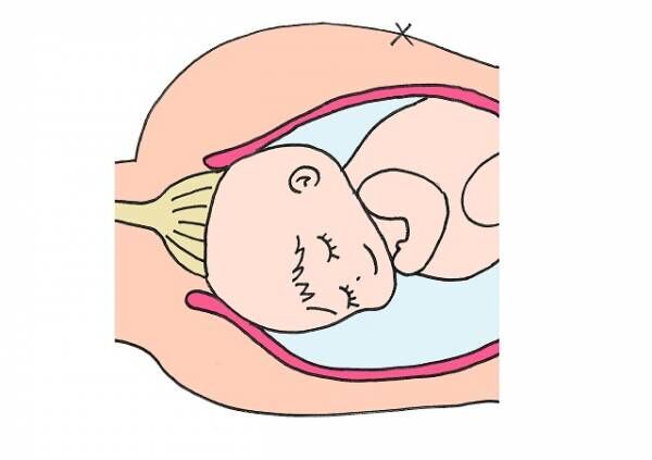 お産の緊急処置 吸引分娩になるときって 吸引分娩の方法とリスク 19年5月7日 ウーマンエキサイト 1 2