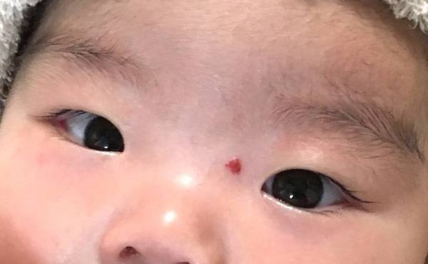 生後1カ月、いちご状血管腫が。「様子を見ましょう」と言われたけど…